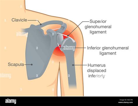 Dislocation Shoulder symptoms or separated Stock Vector Image & Art - Alamy