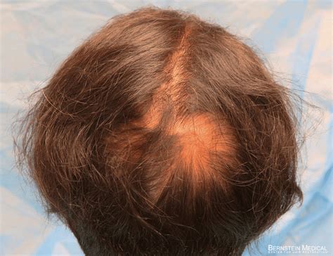 Crown Hair Transplant For Patient Znq Top Scalp Restoration