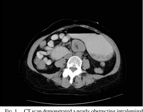 Figure From Duodenal Leiomyoma Causing Duodenojejunal Intussusception