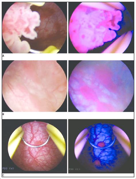 Blue Light Cystoscopy Storz Shelly Lighting