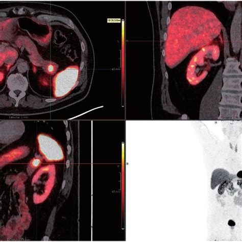 Case 1 Ga 68 Dotatoc PET CT Scan Demonstrating A Pathologic Uptake In