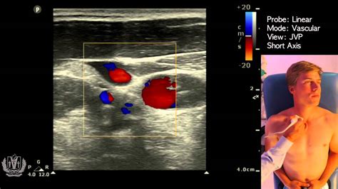 JVP (Jugular Venous Pulsation) Evaluation using Ultrasound - YouTube