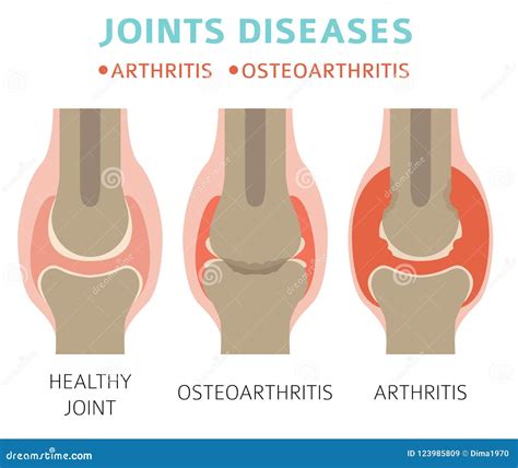 Joints Diseases. Arthritis, Osteoarthritis Symptoms, Treatment I Stock ...