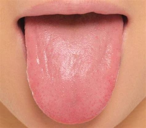 Mouth Anemia Symptoms