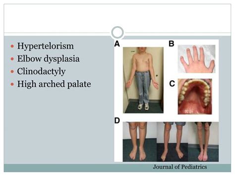 Ppt Klinefelter Syndrome Powerpoint Presentation Free Download Id 5615485