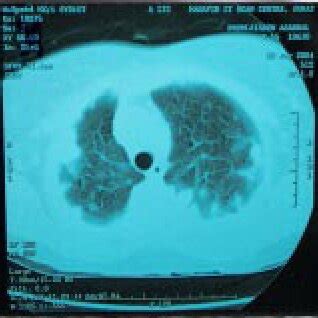 CT scan of chest of 2004 showing multiple subpleural nodules ...