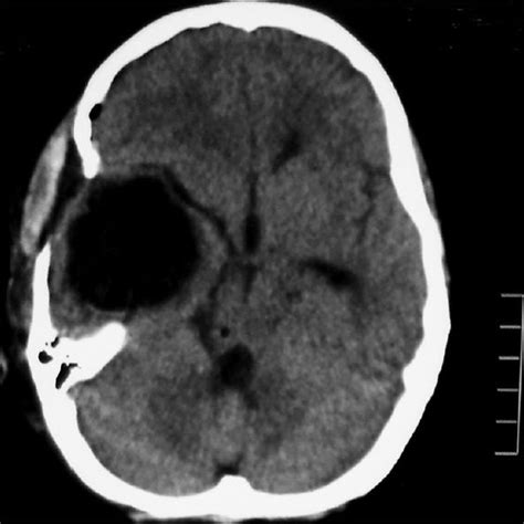 Mri T2w Image Of Brain Showing A Csf Intensity Cystic Lesion In Right