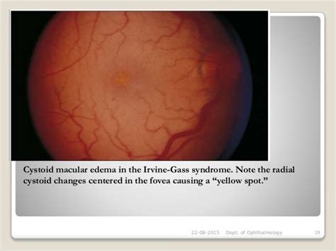 Cystoid macular oedema