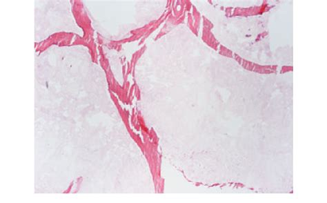 Detail of a trabecular fracture at 200°C. Hematoxylin-eosin 49. | Download Scientific Diagram