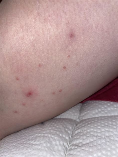 Red Bumps On Inner Thigh R Dermatology