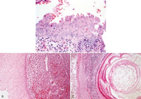 Altered Endometrial Differentiation Metaplasia Clinical Tree