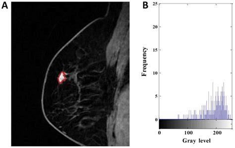 Correlation Between Dcemri Radiomics Features And Ki Expression In