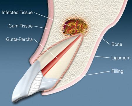 Apicoectomy Brookfield CT | Infected Tooth