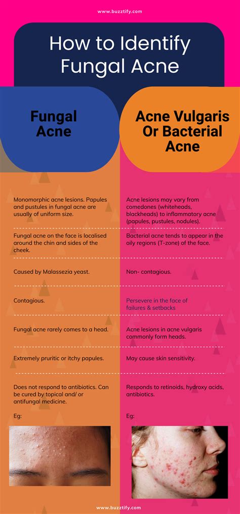 Fungal Acne on Face or Forehead: Causes, Treatments, Symptoms and Routine