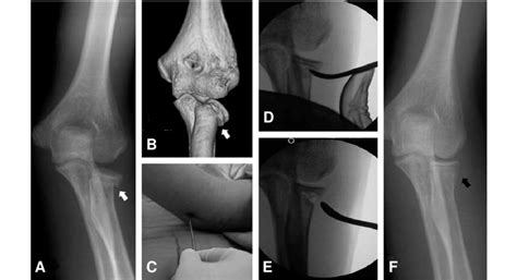 Years Old Male Mason Type Ii Radial Neck Fracture A Preoperative