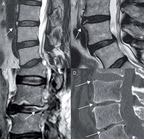 Annular Ligament Tear