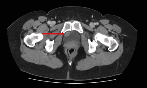 CT urogram (axial view) revealing a 1.5 cm thickening at the level of... | Download Scientific ...