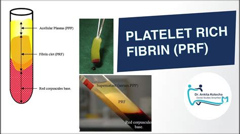 Platelet Rich Fibrin Prf In Periodontics Biologic Properties