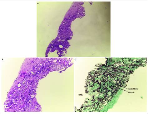 Section Of Upper Lobe Biopsy Showing A B Visceral Pleura Fibrosis