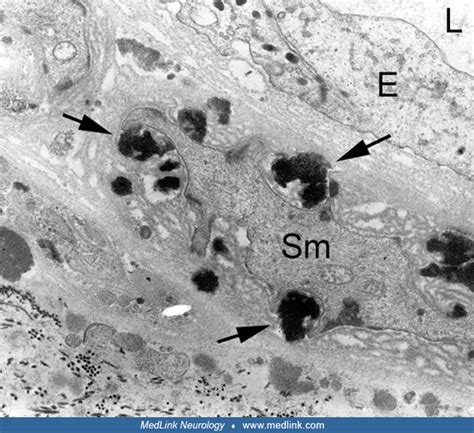 cadasil medlink neurology