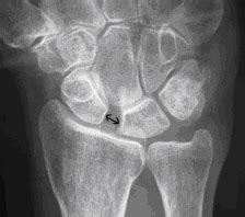 Occult Fractures and Dislocations | Emergency Medicine Cases