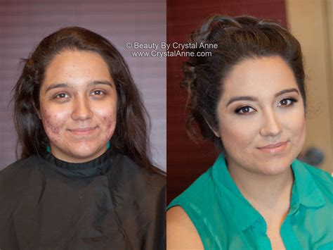 Airbrush Makeup Acne Before And After | Saubhaya Makeup