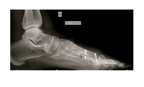 SCARF Osteotomy - FootEducation