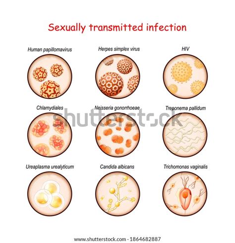 Sexually Transmitted Infection Closeup Causative Agents Stock Vector Royalty Free 1864682887