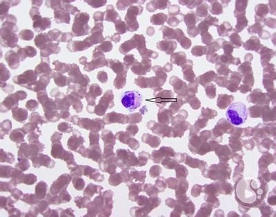 Diplococci on peripheral smear