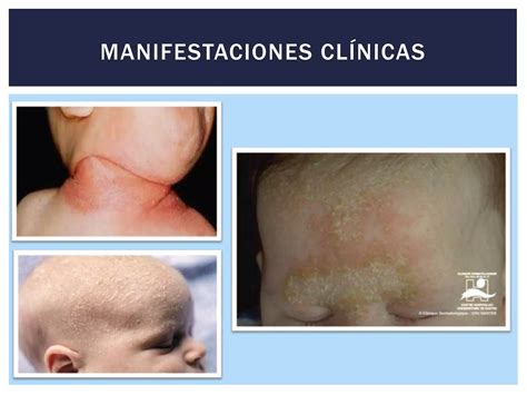 Dermatitis Seborreica Infantil Ppt