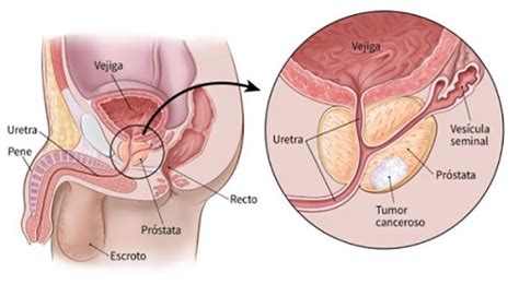 El Parroquiano Salud Hallan Un Nuevo Método Capaz De Detectar El