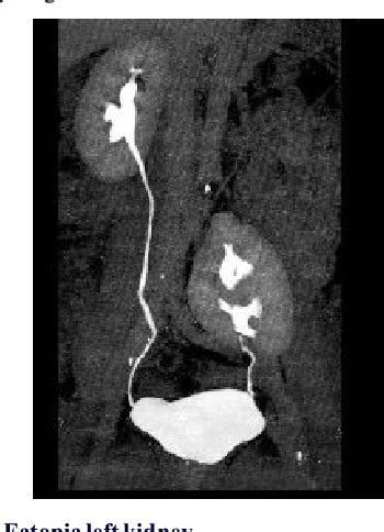 Table 1 From ROLE OF MULTI DETECTOR CT UROGRAPHY IN URINARY TRACT