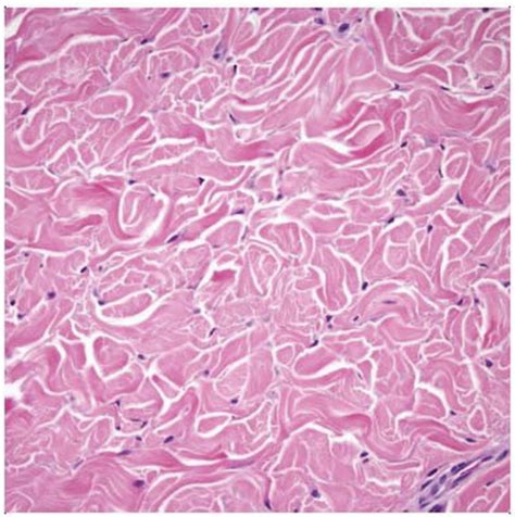 Nuchal And Gardner Fibroma Basicmedical Key