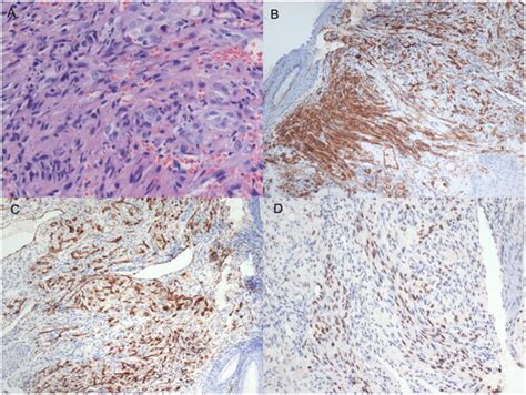 Full Article A Case Report On Kaposis Sarcoma Of The Nasal Cavity In