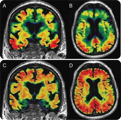 Tau And Amyloid Pet Imaging In Ad Download Scientific Diagram