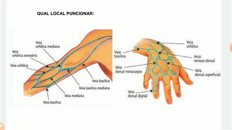Qual A Melhor Veia Para Puncionar Youtube
