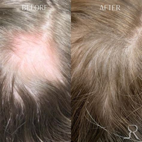 Prf Hair Restoration Before Afters Roberts Aesthetics And Wellness