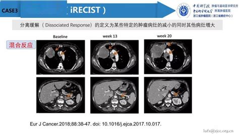 实体瘤疗效评价标准解读肿瘤