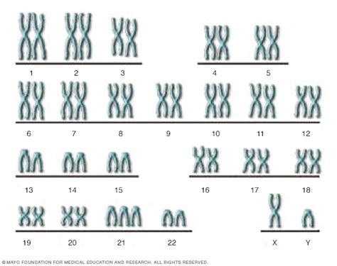 Down syndrome Disease Reference Guide - Drugs.com