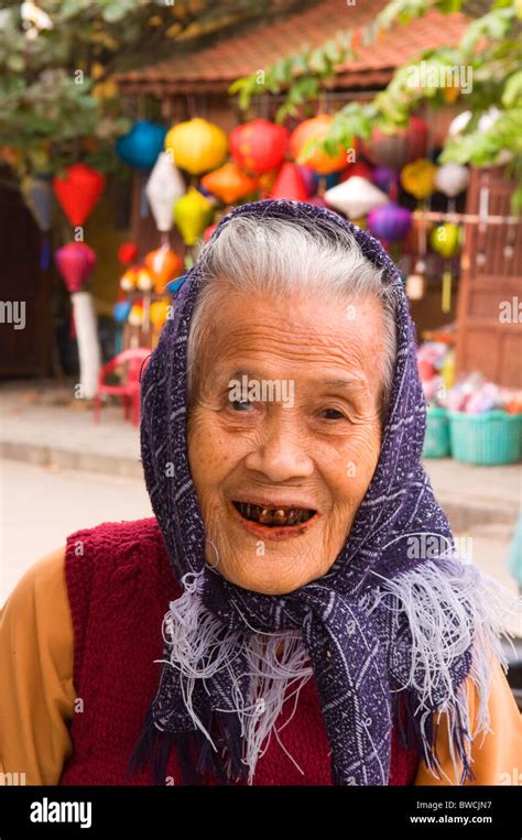 Stained Teeth Hi Res Stock Photography And Images Alamy