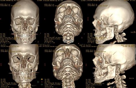 Figure D Reconstructions Of Left Zomc Statpearls Ncbi Bookshelf