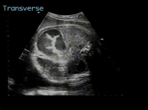 Ileal Atresia Ultrasoundpaedia