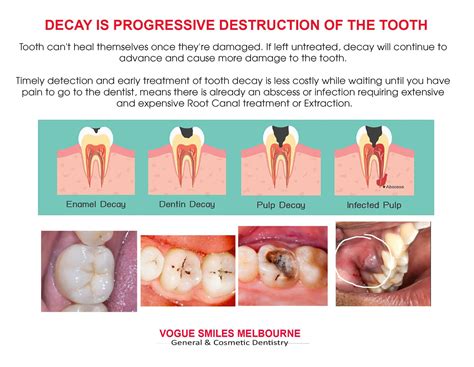 Tooth Decay Treatment Melbourne Cbd Vogue Smiles