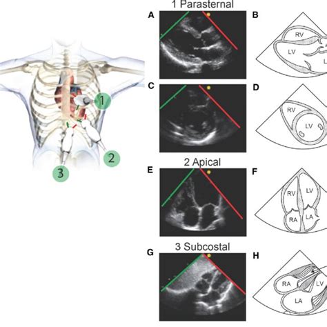 The Focused Cardiac Ultrasound Study Focus Exam This Includes These