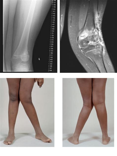 Decreased Ankle Dorsiflexion Is Associated With Dynamic Knee Valgus