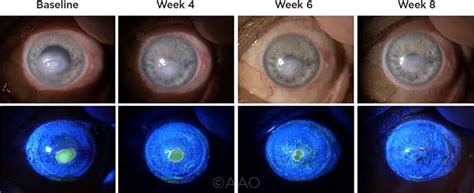 Neurotrophic Keratitis Topical Rhngf Is Safe And Effective American Academy Of Ophthalmology