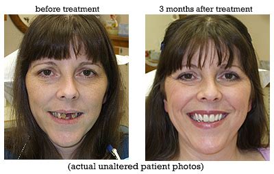 Natural Looking Dentures Before And After