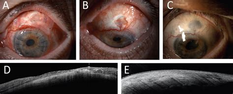 Acanthamoeba Scleral Abscess Reoccurring After Penetrating Keratoplasty Bmj Case Reports