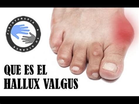 Qué es un Juanete o Hallux Valgus Clínica Estemedic