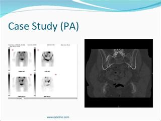 Sacroplasty Presentation | PPT